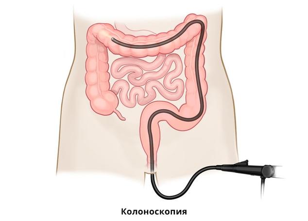 Диета После Удаления Полипа При Колоноскопии