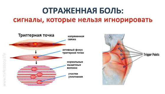 Отраженная боль, которую нельзя игнорировать