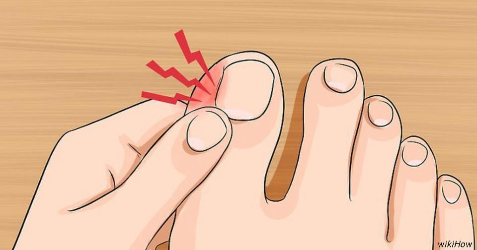 6 удивительно эффективных способов избавиться от вросших ногтей на ногах