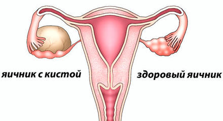 Киста яичника: что нужно знать женщинам после 40