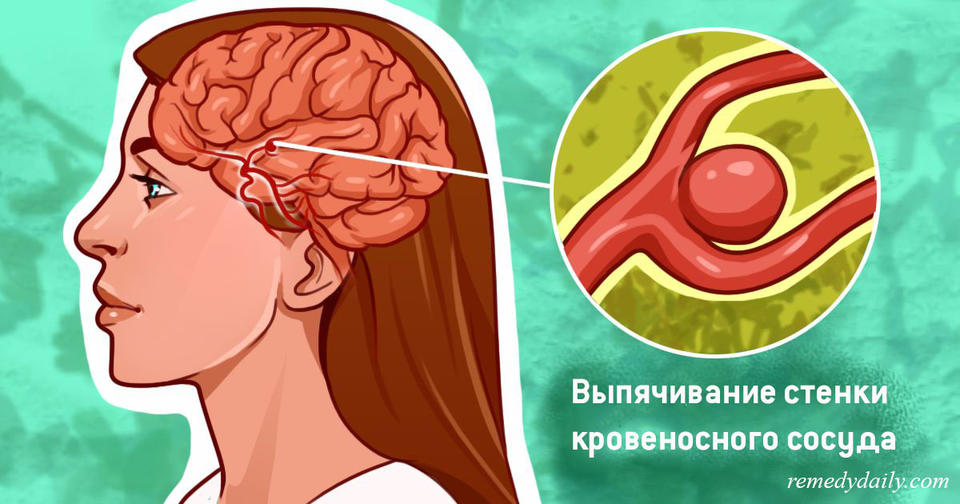 Все буквально все, что нужно знать об аневризме головного мозга