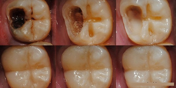 Вот 5 шагов, чтобы остановить кариес и спасти свои зубы. Можете удалить номер стоматолога