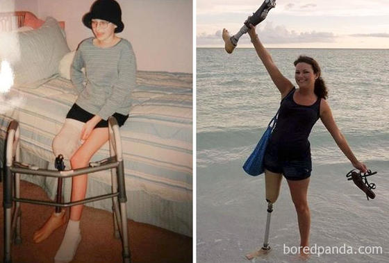 25 фото людей, которые смогли победить рак и теперь знают, что значит ″ценить жизнь″