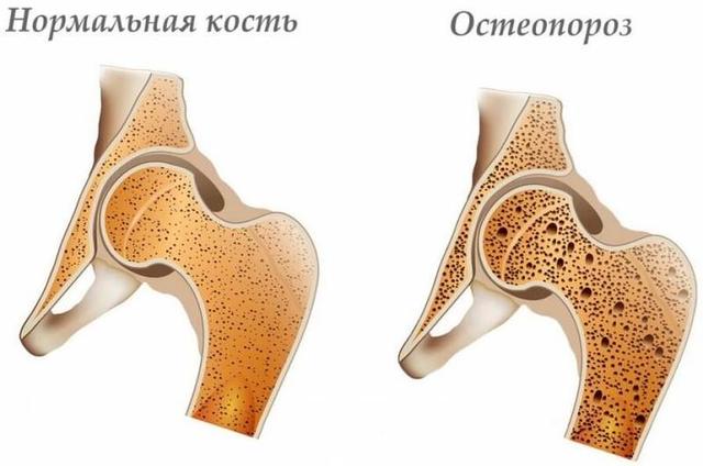 Вся правда об остеопорозе