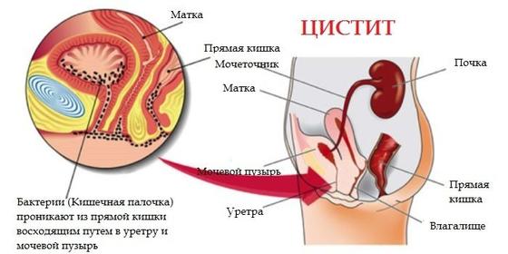 Лечение цистита у женщин: какие таблетки и травы помогут