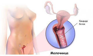 Многие женщины страдают от грибковых инфекций,но вылечиться от них возможно и в домашних условиях!