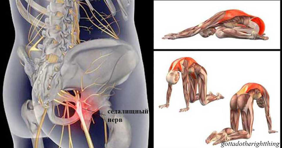 11 упражнений, которые избавят вас от боли в спине , когда воспалился седалищный нерв