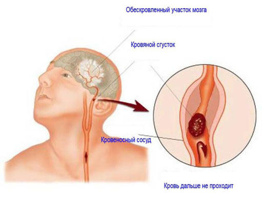 Чтобы понять, инсульт у человека или нет, пусть сделает эти 3 вещи! 