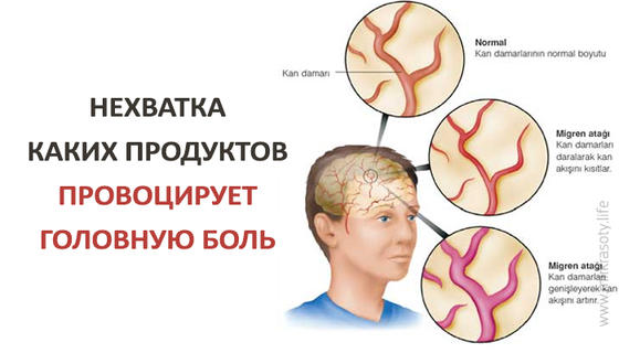 Нехватка каких продуктов провоцирует головную боль