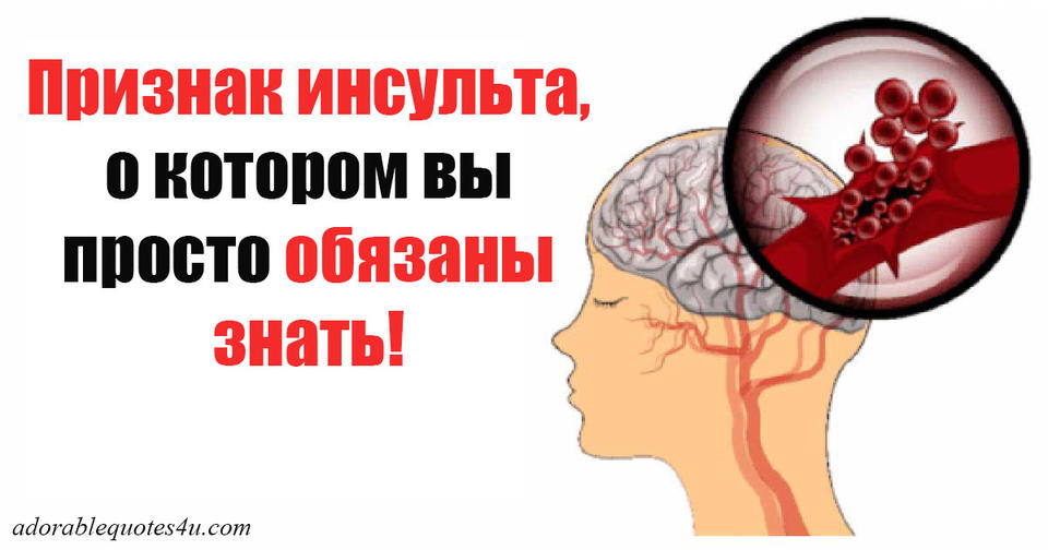 Чтобы понять, инсульт у человека или нет, пусть сделает эти 3 вещи! 