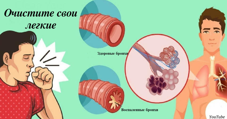 5 домашних средств от мокроты в горле и легких. Не ждите пневмонии   действуйте!  