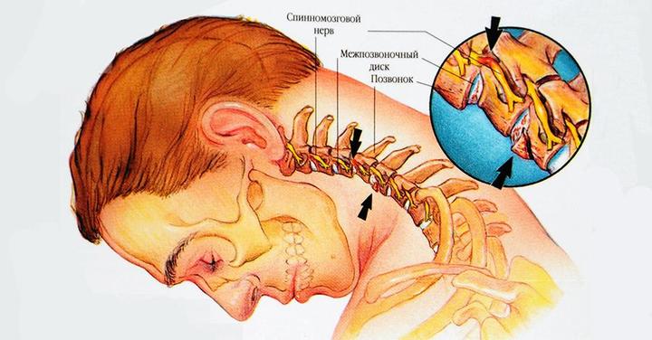 Остеохондроз шейного отдела позвоночника: эффективное лечение