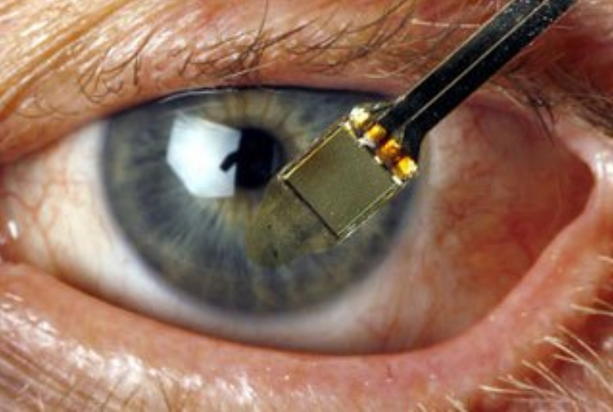 В Италии женщине пересадили искусственную сетчатку глаза. Впервые в мире! 