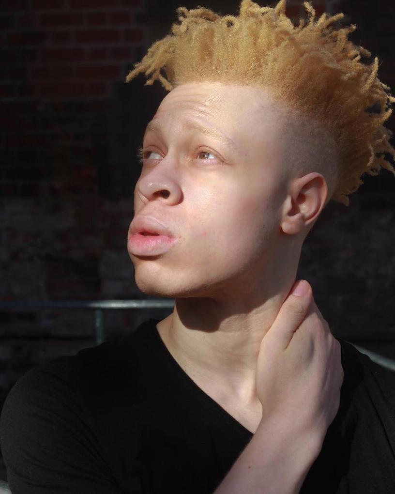 Этот парень-альбинос проделал долгий путь от «гадкого утёнка» до востребованной модели. И совсем неудивительно, что он добился успеха