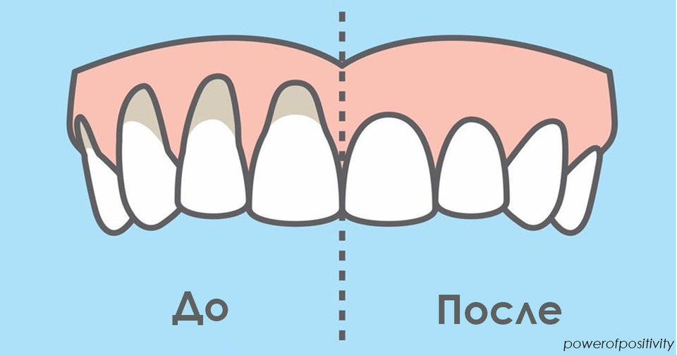 Вот 10 лучших домашних способов исцелить оголенные десна. Какой   ваш? 