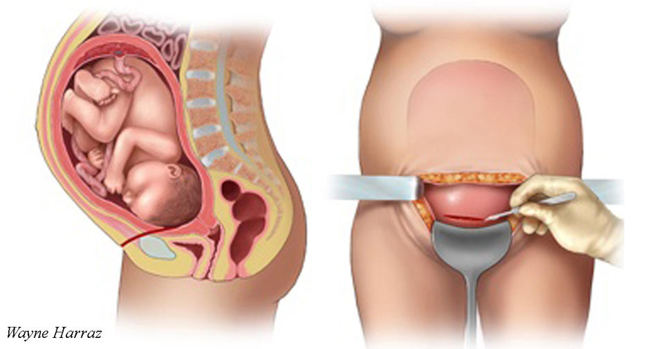 Ужасная правда о кесаревом сечении, которую не расскажет ни одна женщина