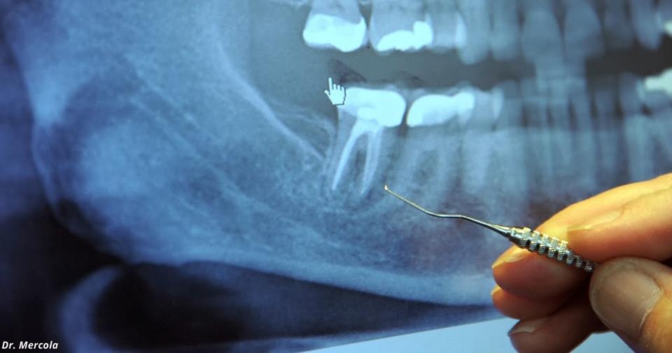 Очень странное открытие: 97% больных раком делали эту процедуру у стоматолога!