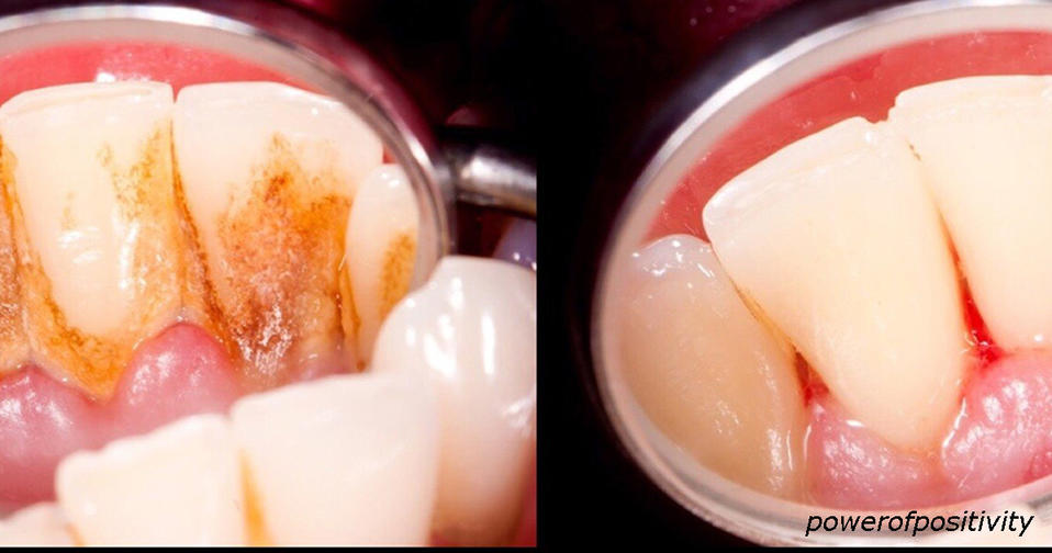 Вот 4 реальных способа убрать зубной камень без стоматолога Уйдет, как налет!