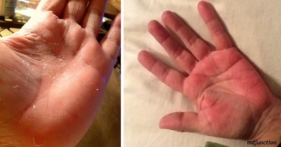 7 опасных болезней, которые можно определить по состоянию рук Чаще присматривайтесь к рукам!