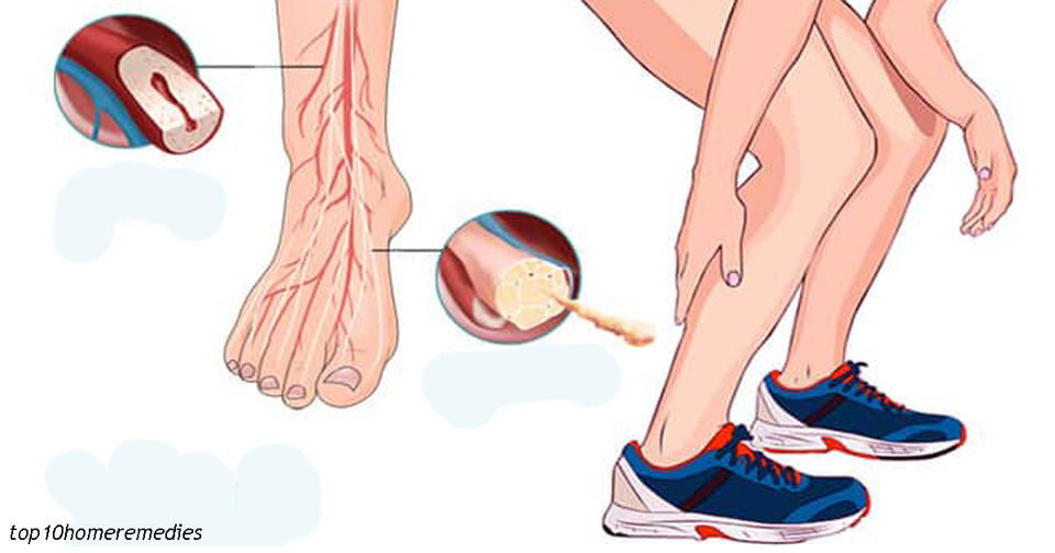 Судороги в ногах: Вот откуда они берутся, и как с этим справиться Когда свело ногу.