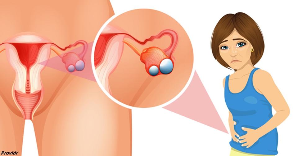 4 ранних симптома рака яичников, о которых должна знать каждая женщина На ранней стадии всё лечится!