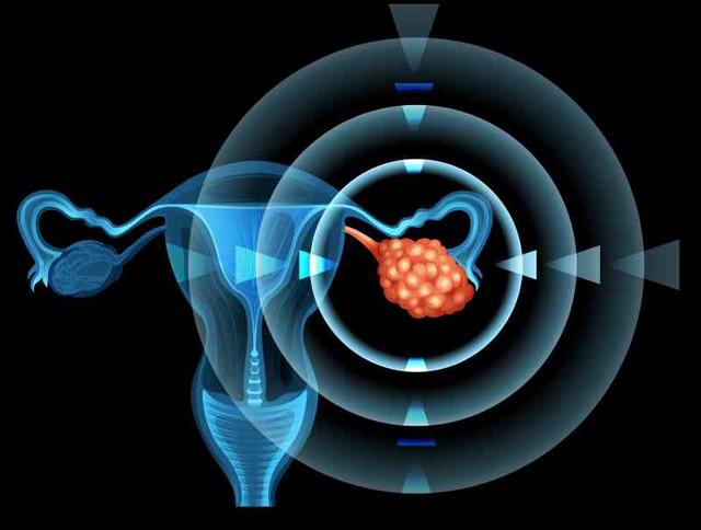 4 ранних симптома рака яичников, о которых должна знать каждая женщина На ранней стадии всё лечится!