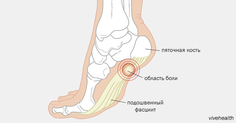 Боль в стопе может быть признаком 6 опасных патологий! Вот на что обратить внимание Такое нельзя игнорировать.