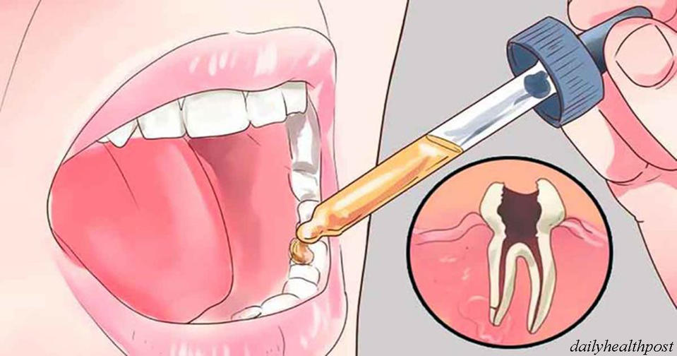 Стоматолог не расскажет: Есть 12 домашних способов снять зубную боль Про последствия не слышали, все натуральное.