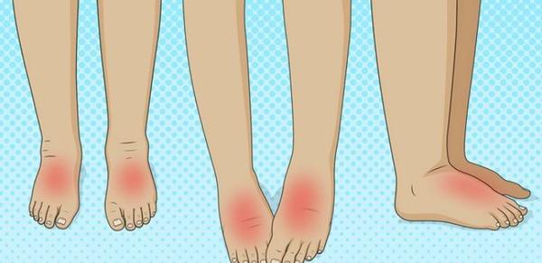 Опухшие ноги: 8 тревожных болезней, о которых они предупреждают Главное - вовремя обнаружить симптомы.
