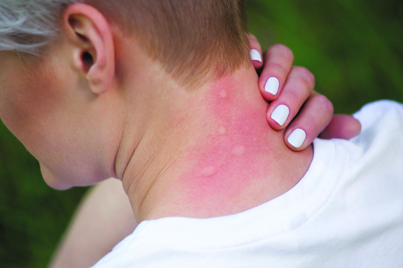 Если после укуса комара у вас набухает кожа, это может быть синдром Скитера Вот что это такое.