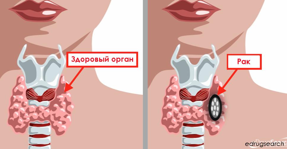 30 симптомов хронического расстройства щитовидной железы Обратите внимание!