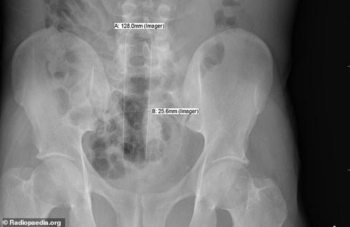 10 странных вещей, застрявших внутри людей, которые попали в больницу Ничего себе!