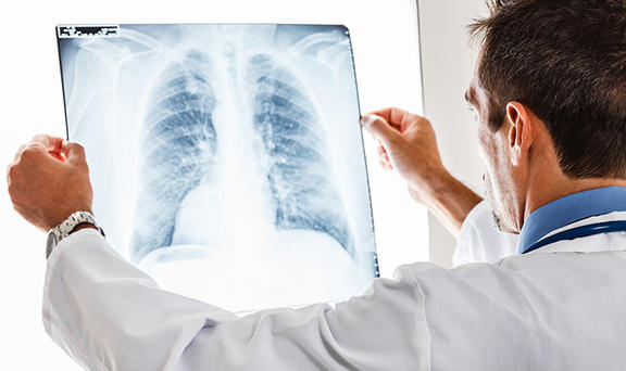 12 ранних признаков рака лёгких, которые нельзя игнорировать И сразу же обратиться за квалифицированной помощью!