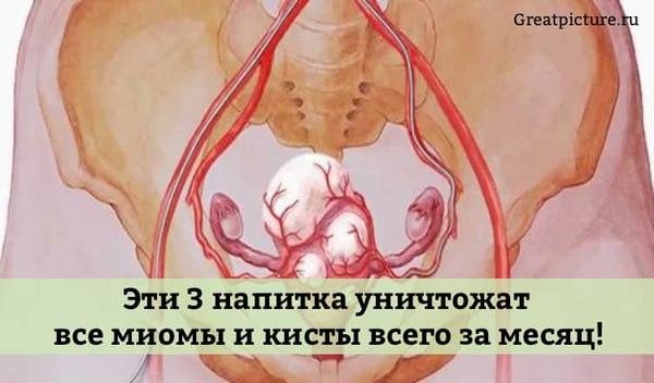 Эти 3 напитка уничтожат все миомы и кисты всего за месяц!