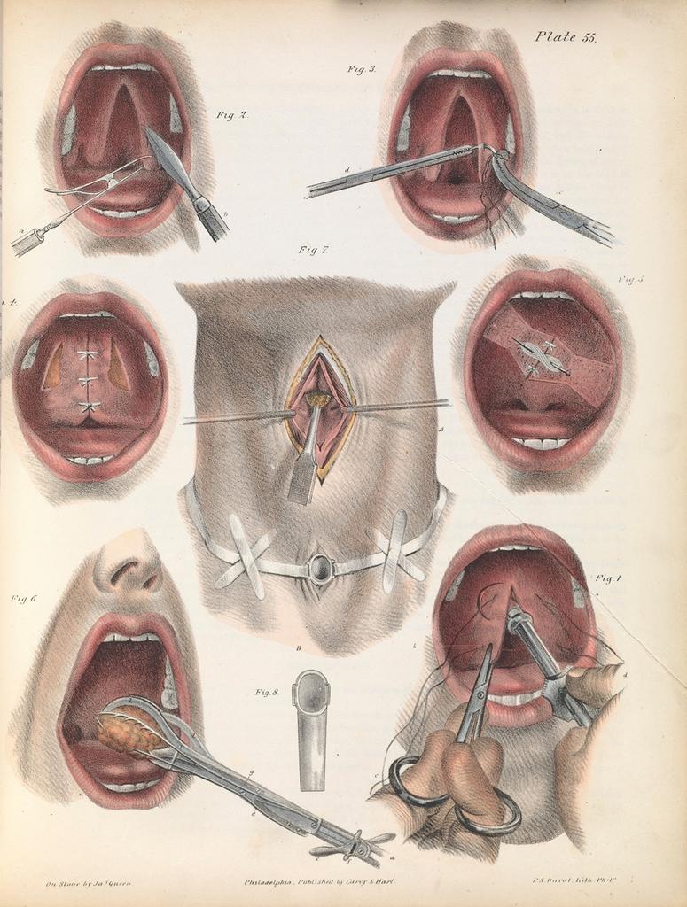 Картинки для хирургов XIX века о том, как правильно удалять разные части тела