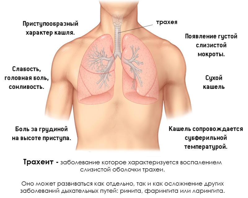 Как отличить друг от друга трахеит, бронхит и пневмонию?