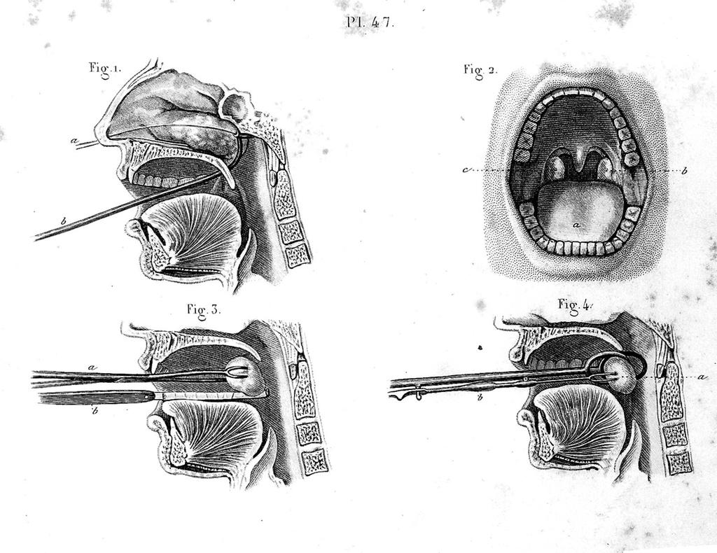 Картинки для хирургов XIX века о том, как правильно удалять разные части тела