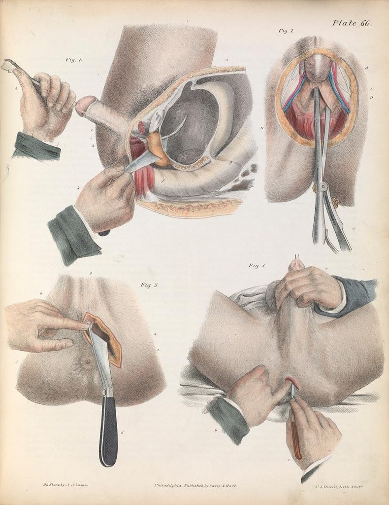 Картинки для хирургов XIX века о том, как правильно удалять разные части тела