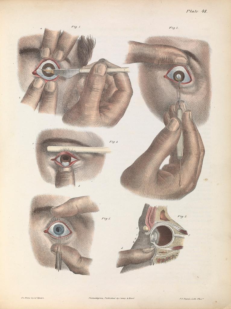 Картинки для хирургов XIX века о том, как правильно удалять разные части тела