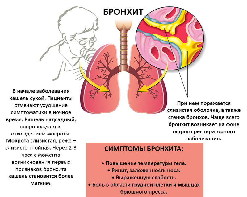 Как отличить друг от друга трахеит, бронхит и пневмонию?