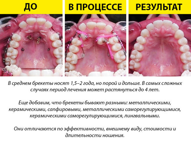 11 фактов о брекетах, которые нужно знать перед их установкой