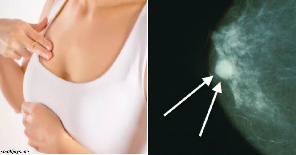 10 ранних признаков рака молочной железы, которые должна знать каждая женщина