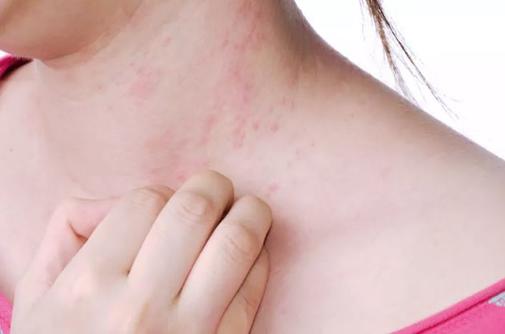 15 неочевидных симптомов аллергии, о которых большинство людей даже не догадывается