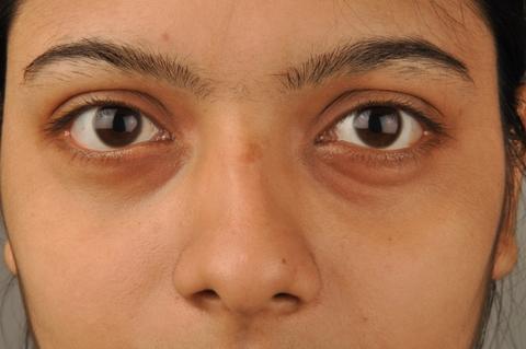 12 хитростей, которые помогут уменьшить синяки под глазами