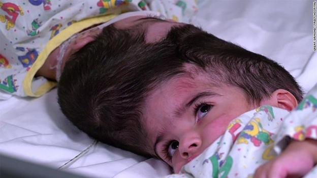 Сиамские близнецы со сросшимися головами пережили 50-часовую операцию