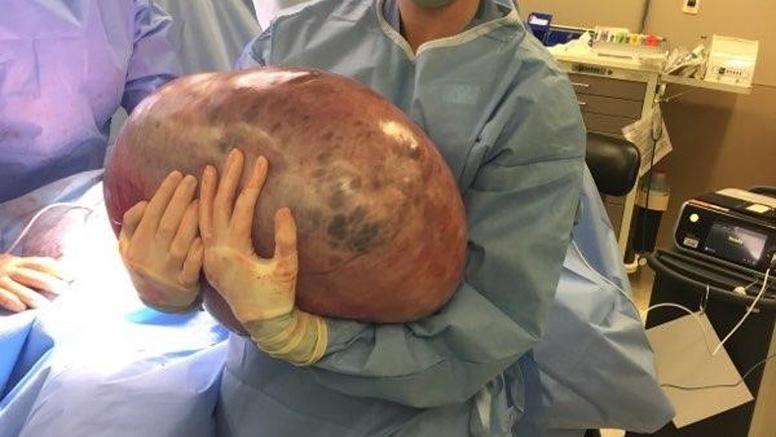 Американке удалили 60-килограммовую опухоль яичника. Вот как это было
