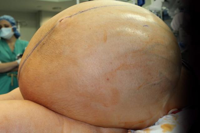 Американке удалили 60 килограммовую опухоль яичника. Вот как это было