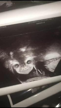 Малышка на УЗИ решила развернуться к аппарату лицом, и мама получила шокирующее фото
