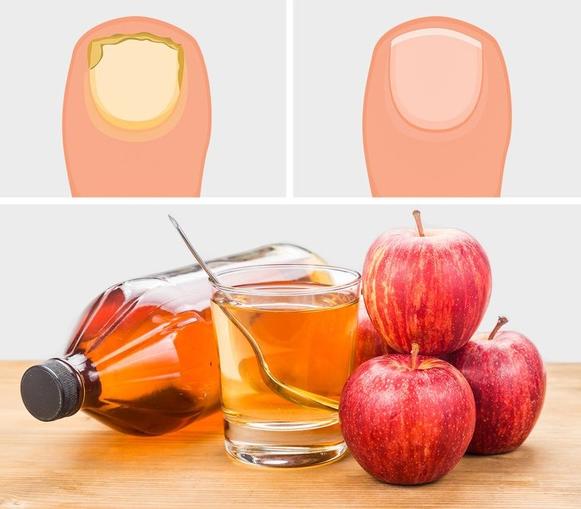 Как яблочный уксус может упростить вашу жизнь: он может поправить ваше здоровье, помочь в хозяйстве и при приготовлении пищи