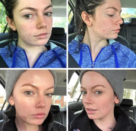 Секреты от девушек, которым удалось сделать кожу своего лица совершенной: всего несколько минут в день   и проблем как не бывало